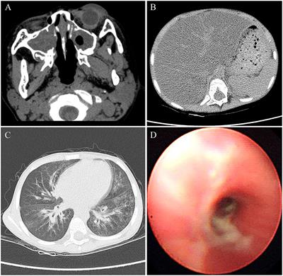 Liver Failure in a Chinese Cystic Fibrosis Child With Homozygous R553X Mutation